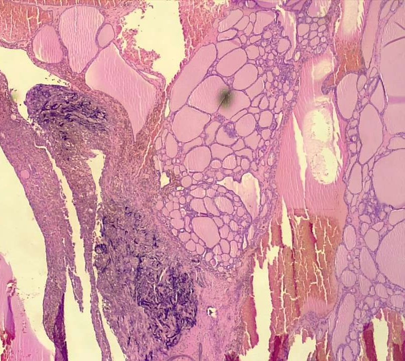 BuddingLiska's tweet photo. Wow moment: Gamna-Gandy bodies. Spheroidal yellow-brown foci of dense fibrous tissue and collagenous fibers composed of calcium and hemosiderin pigments. Sites: spleen, atrial myxomas, lymph nodes, thymoma, follicular adenoma of thyroid (and more) Thank you @christiestwit https://t.co/c8cBzbwZBG