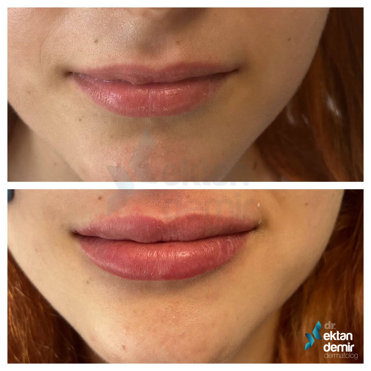 Russian lips dudak dolgusu benzer dolgu uygulamalarında olduğu gibi, dudaklardaki hacim kaybını telafi etmeye odaklanmaktadır. 
ektandemir.com/russian-lips-d…

#russianlips #rustekniği #rusdudakdolgusu #istanbul #dudakdolgusu #dolgu #ektandemir #kadın #lips #dudakdolgu #dudak #hifu