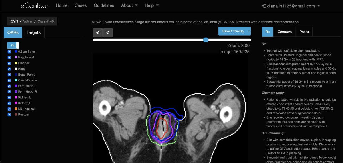 eContourRadOnc's tweet image. 🚨 We&apos;re coming into August with some 🔥 new #econtour cases! See 👇:

- Case 140 (Vulvar) ➡️ econtour.org/cases/140; 🙏 courtesy of Dr. @jjnaylor02 &amp;amp; @WinshipAtEmory 

- Case 151 (Pancreatic SBRT) ➡️ econtour.org/cases/151; 🙏 courtesy of Dr. Elham Rahim &amp;amp; @StanfordRO_Res