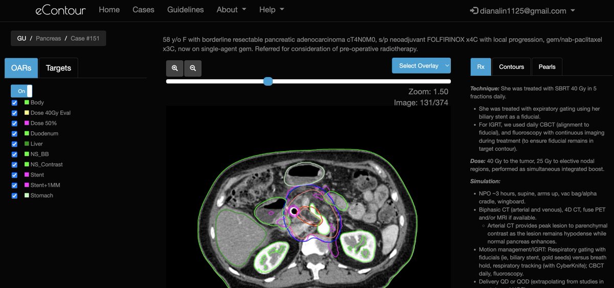 eContourRadOnc's tweet image. 🚨 We&apos;re coming into August with some 🔥 new #econtour cases! See 👇:

- Case 140 (Vulvar) ➡️ econtour.org/cases/140; 🙏 courtesy of Dr. @jjnaylor02 &amp;amp; @WinshipAtEmory 

- Case 151 (Pancreatic SBRT) ➡️ econtour.org/cases/151; 🙏 courtesy of Dr. Elham Rahim &amp;amp; @StanfordRO_Res