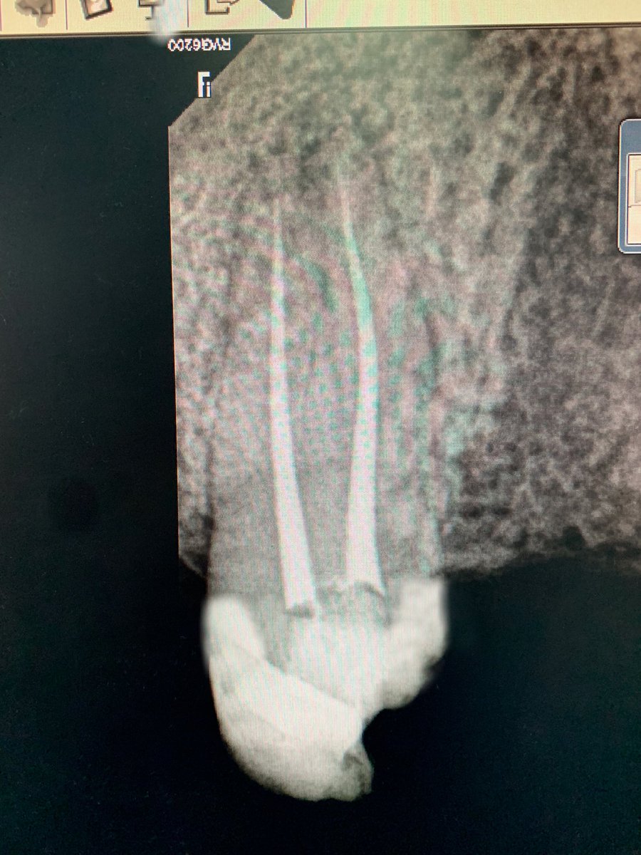 a_sa_dent's tweet photo. RCT of #14  in single visit 
علاج عصب لضاحك علوي في جلسة واحدة 
#kku
#kku_dental
#Endodontic
#Denatl
#rubber_dam 
For more photos 
https://t.co/S6RNFFiC9Q https://t.co/tR5vS0Nd6d