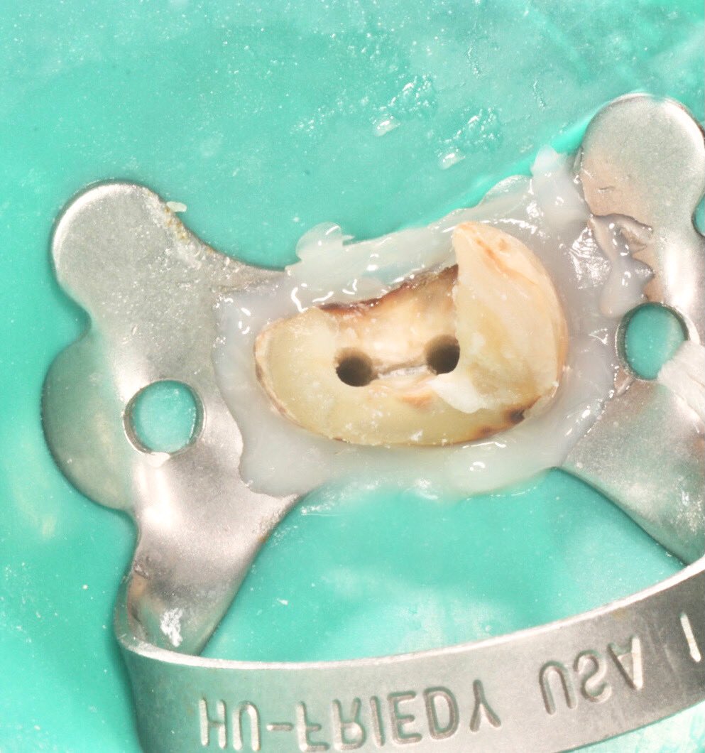 a_sa_dent's tweet photo. RCT of #14  in single visit 
علاج عصب لضاحك علوي في جلسة واحدة 
#kku
#kku_dental
#Endodontic
#Denatl
#rubber_dam 
For more photos 
https://t.co/S6RNFFiC9Q https://t.co/tR5vS0Nd6d