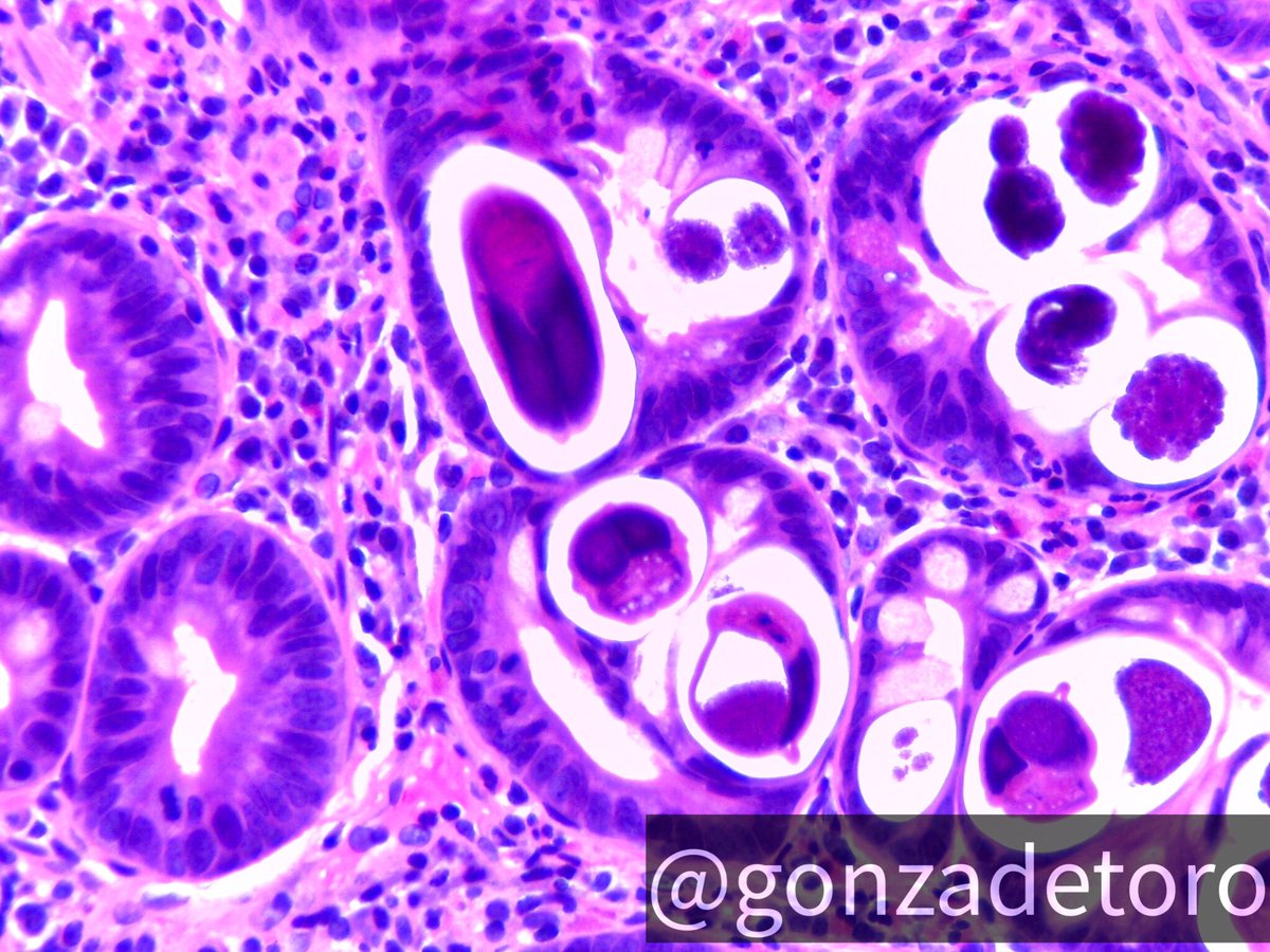 Duodenal biopsy
#PathTwitter #GIpath #MedTwitter #pathology #patheducation #Critters #pathboards @c_castrodad @ridin_bk_MD @Dr_Brian_Cox @ALBoothMD @HansiniMD @RSekhri_MD @KurtSchabergeosi