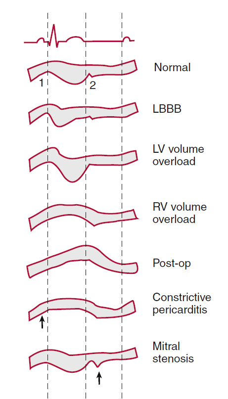 Patterns of septal motion on M-mode #echofirst 
Click on 'alt' for description
#MedEd #POCUS #IMPOCUS 
Courtesy: Otto cardiology textbook, chapter 6