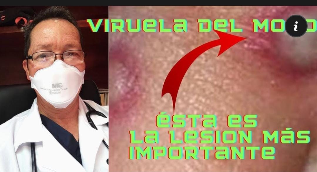 JavRubalcaba's tweet photo. Hola les comparto este breve video sobre cómo identificar las lesiones en la #ViruelaDelMono   a cuidarse mucho!! 
https://t.co/tMNqNAilti https://t.co/fPfRpfbmOv