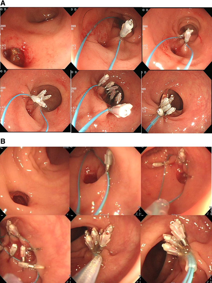 pinoygastro's tweet photo. In last night’s #EndoscopicRadiologicConference, we discussed how purse string suture using endoloop and hemoclips can be used as an alternative to #Ovesco in closing a large duodenal perforation. Anybody has experience on this? #GItwitter https://t.co/gOs0cVF98V