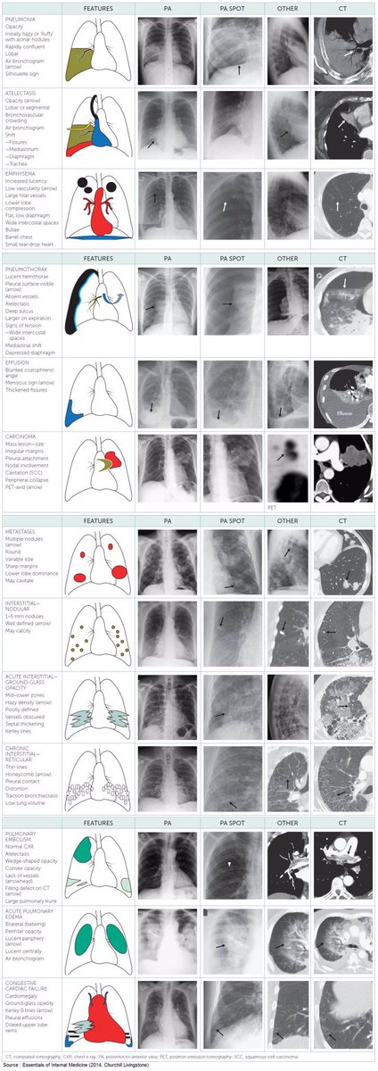 Radiographic Features of #Pulmonary Diseases

#radiology #radiography #radiographystudent  #FOAMrad #radres #chest #radtwitter #MedTwitter #MedEd #Medstudenttwitter #INNOMed