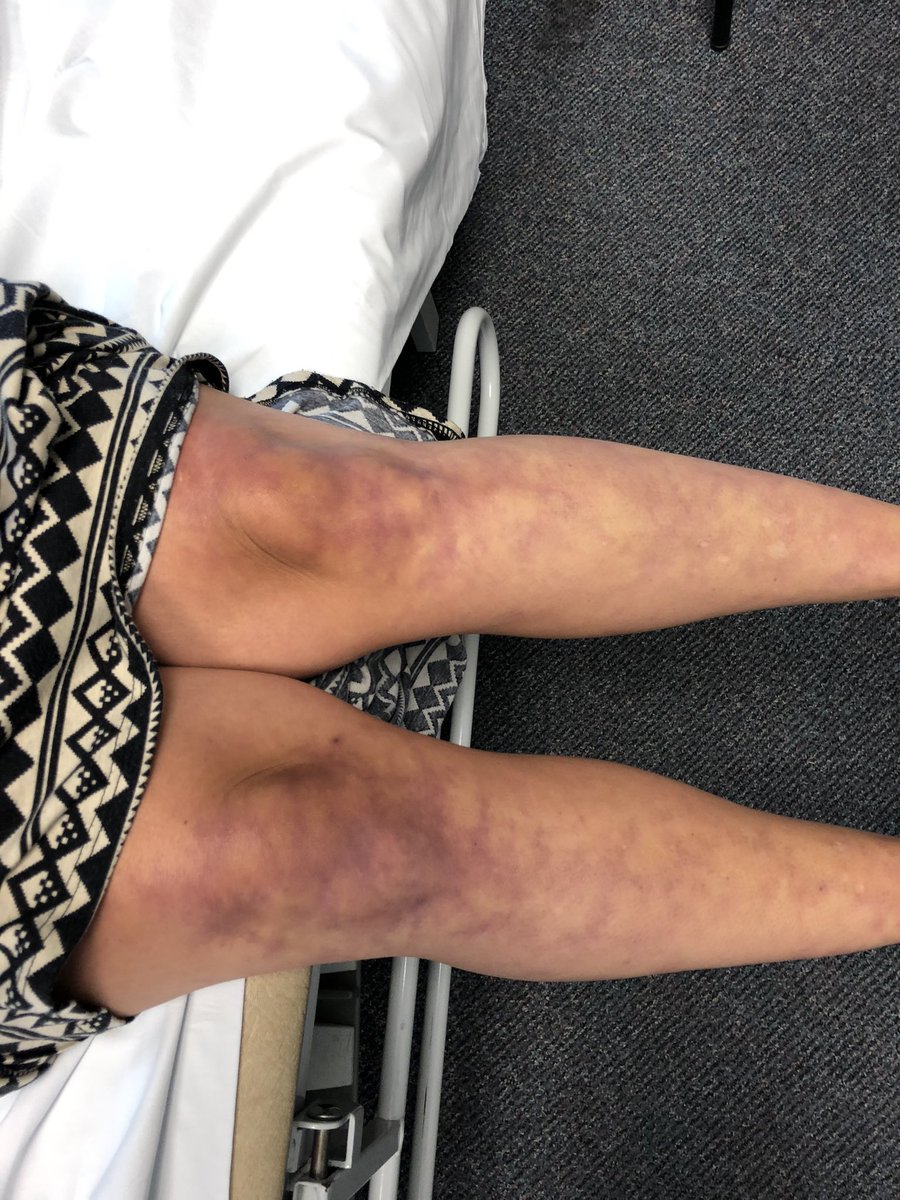 Janetbirdope's tweet photo. #ClinicalPearl See #livedo #reticularis and neuropathy with past ulcer on leg and #Raynaud’s. 1 guess only per entry! You can do it. Hint NOT #SLE https://t.co/Zvhx7qhE5j