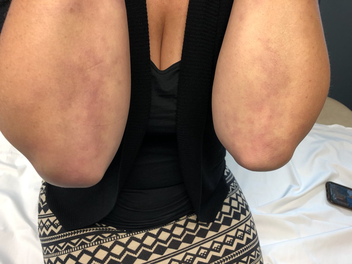 Janetbirdope's tweet photo. #ClinicalPearl See #livedo #reticularis and neuropathy with past ulcer on leg and #Raynaud’s. 1 guess only per entry! You can do it. Hint NOT #SLE https://t.co/Zvhx7qhE5j