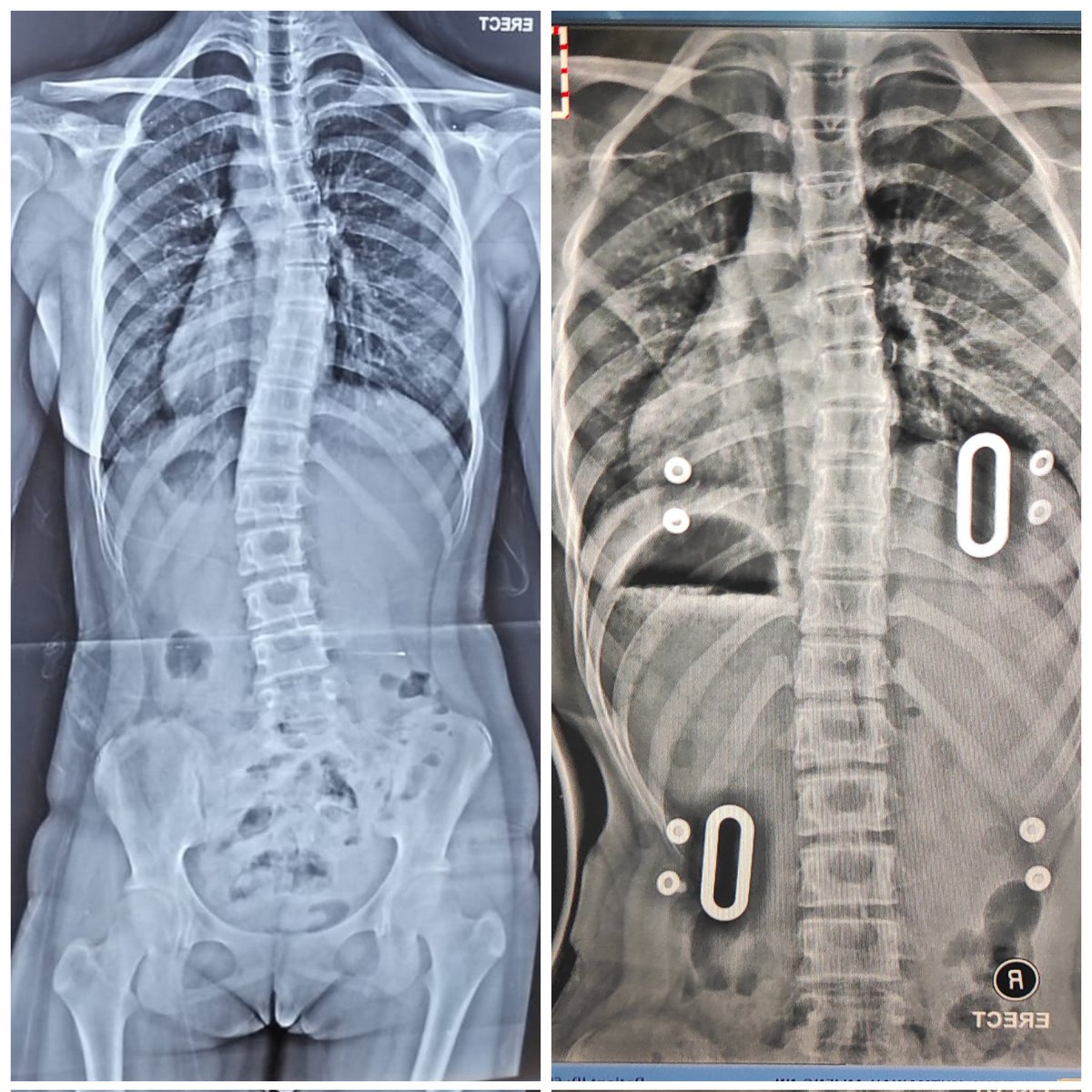 May brace is function well, happy me!!! 

adolescent idiopathic scoliosis
