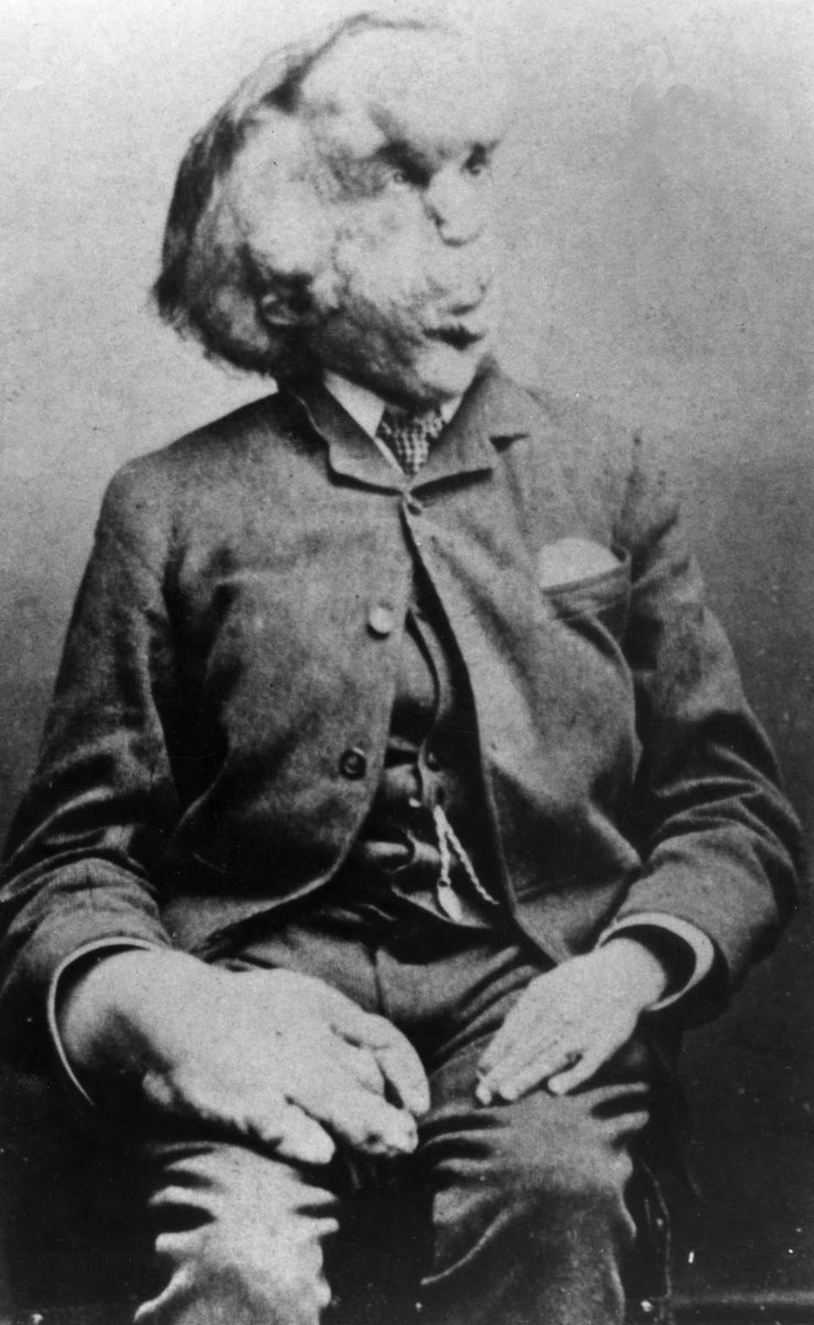 MediaoutletCom's tweet photo. #AdventuresInHistory!
#OTD #TDIH #August5, 1862: #HBD #JosephMerrick. #JohnMerrick #TheElephantMan #ElephantMan #JohnMerrick #TheDisabled #SideshowPerformers #FreakShowPeformers #MedicalAnomolies
https://t.co/NYwrE5mqBc https://t.co/V4JEO1twxN