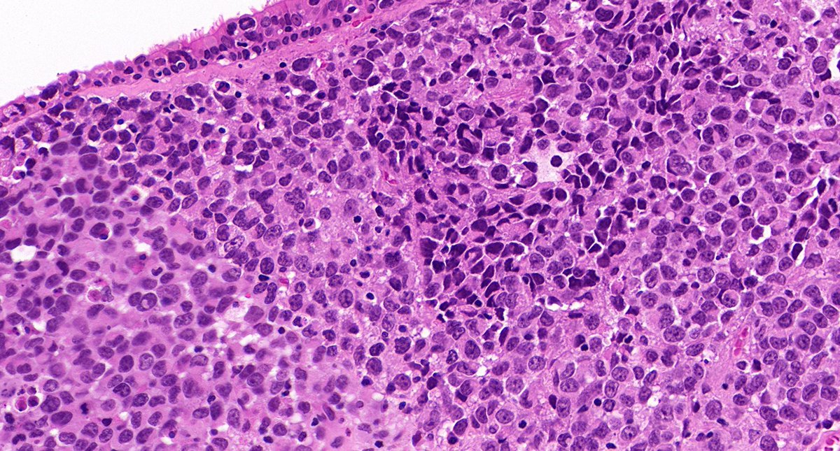 TristanRutland7's tweet photo. Case 1

Nasal septum, adult

#ENTpath #Dermpath #BSTpath #Pathresidents #Pathtwitter https://t.co/sZUxE0Jfqe