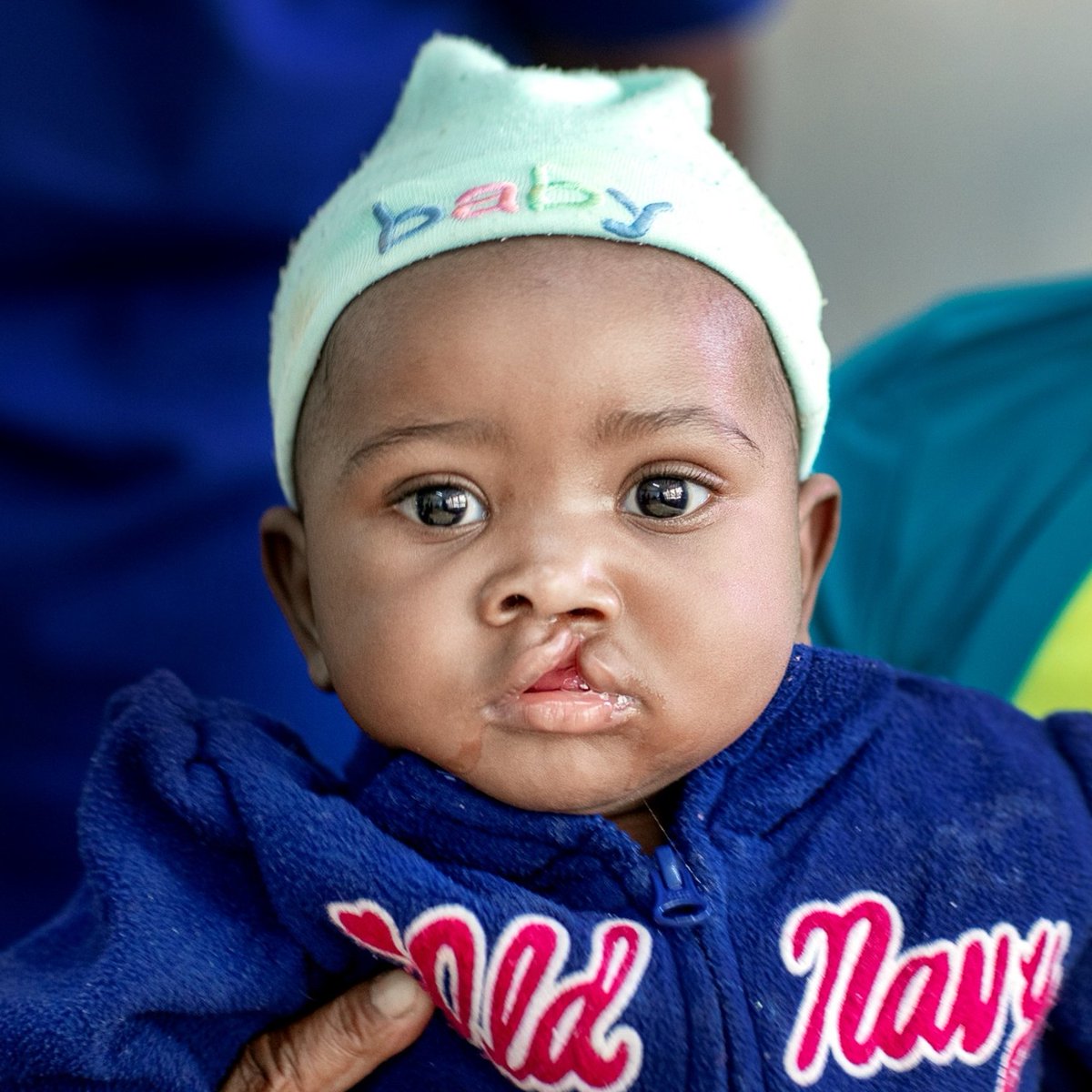 OpSmileIrl's tweet photo. We think Mercy's smile could light up any room, don't you? 🤩❤️  Thanks to #OperationSmile #Malawi she got her surgery at 6 months old so can grow up without facing the bullying &amp; isolation that many children with cleft conditions have to experience. #SharingSmiles #CleftCare https://t.co/d6Z5kx6ReU