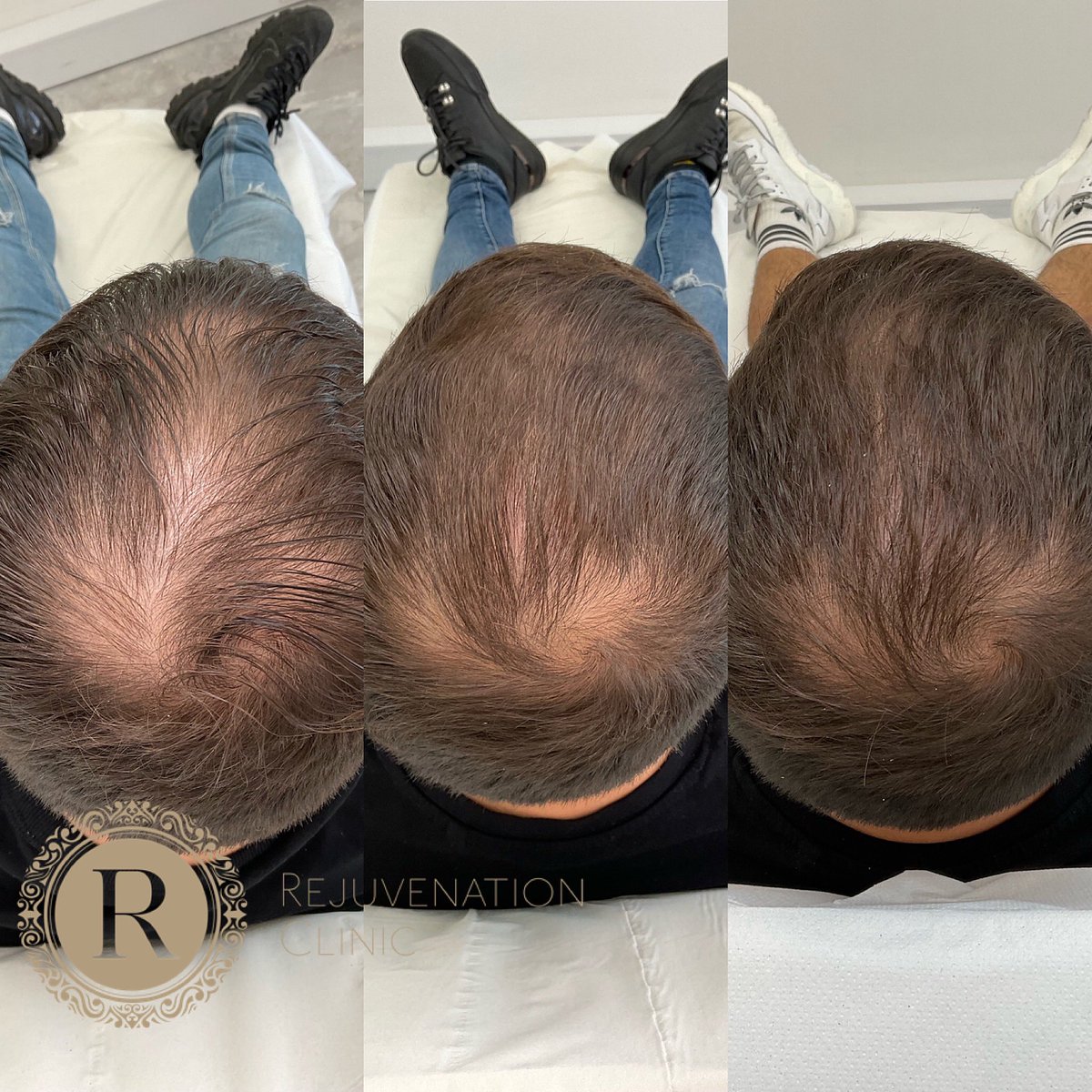 3 sessions of PRP and the results are only getting better. 💉✨

Don’t let hair-loss effect your confidence. Message us today to for your free consultation. 

#PRPhair #HairTransplant #Kent