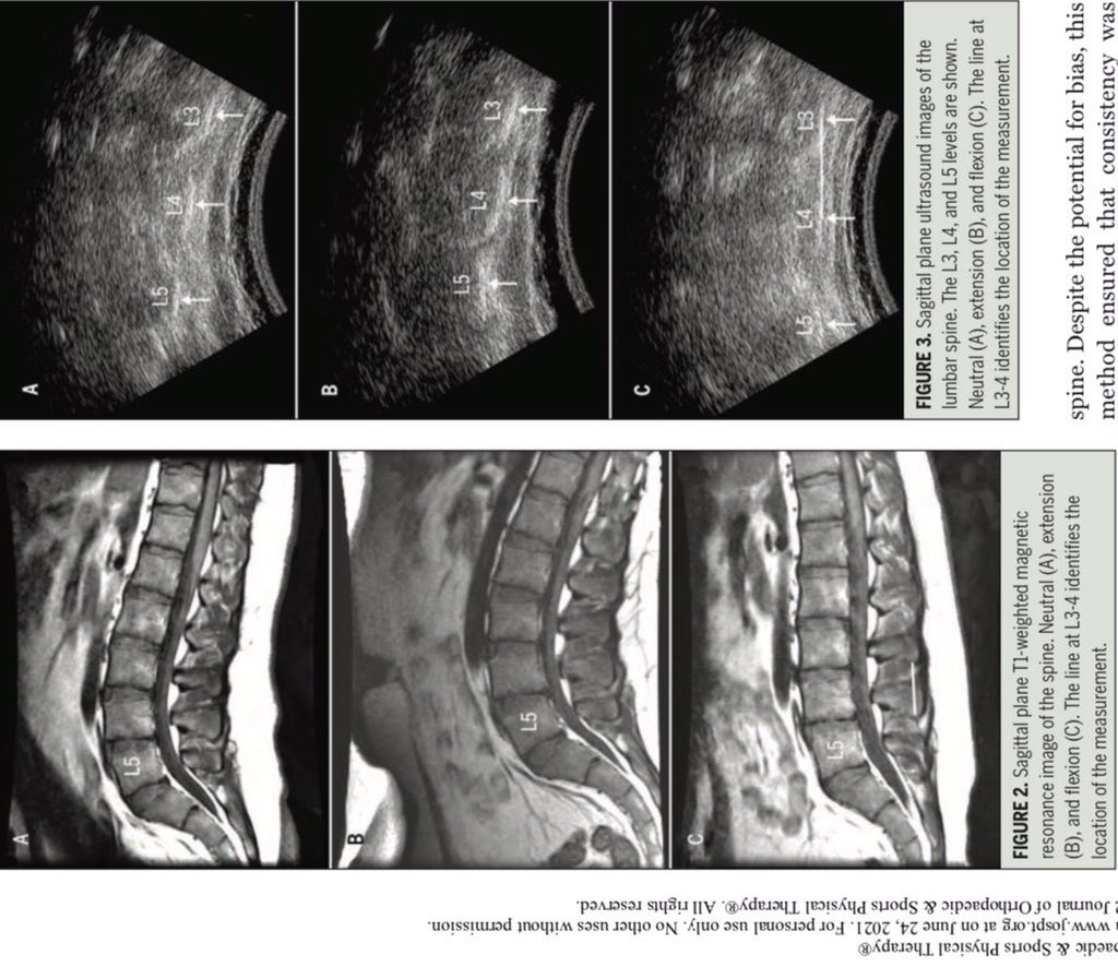 A ponderance 

When people talk about “rounding the lumbar spine” for lifting, there is only one problem, the lumbar spine does NOT round, at most it straightens. jospt.org/doi/pdf/10.251…