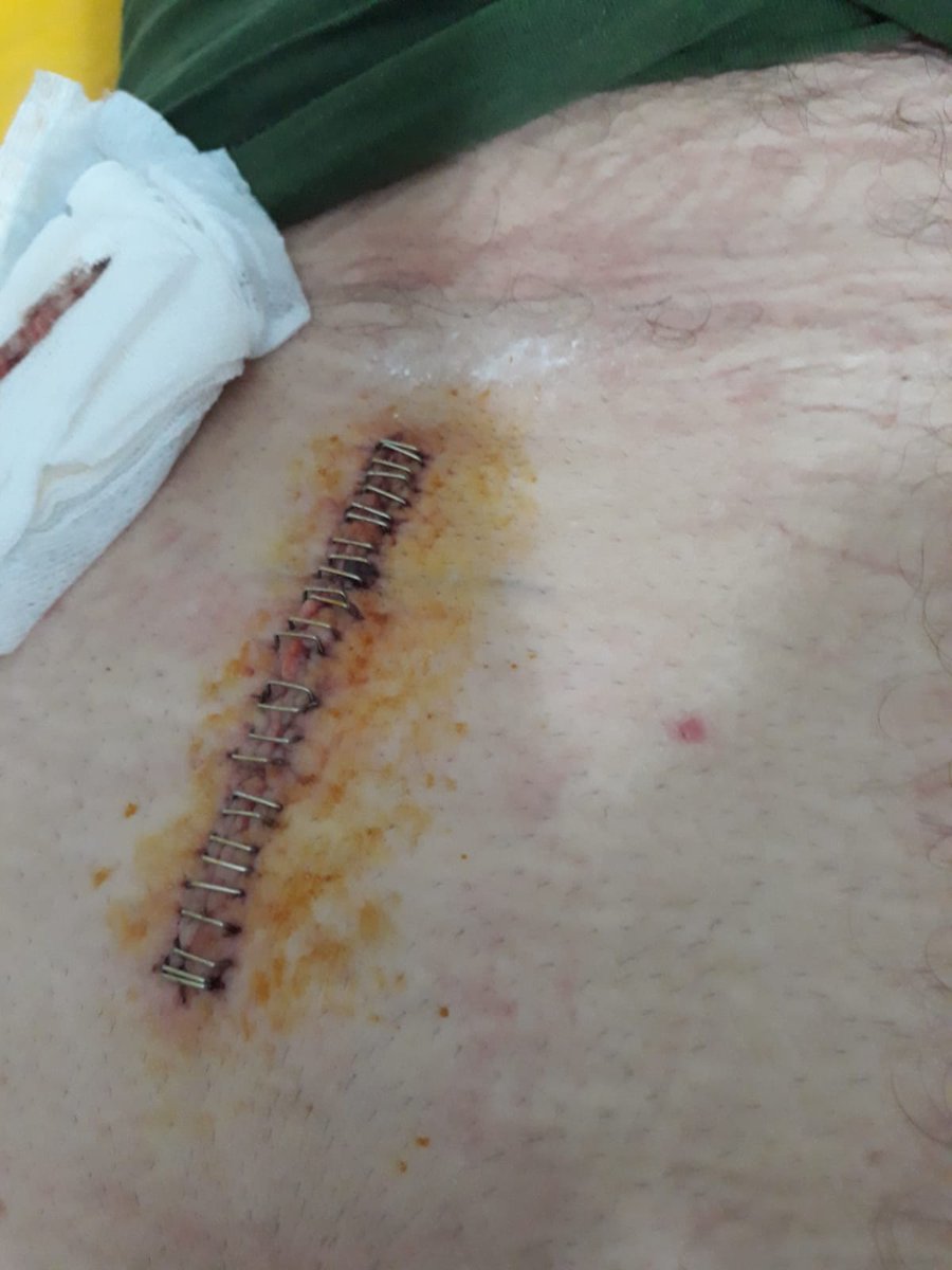 antilaikkafa's tweet photo. Elem bir hastalık sebebi ile çalışamaz hale geldim. 3 kez ameliyat oldum ve çalışamıyorum maalesef. 18 gün hastanede tedavi gördüm. Eşim engelli. Büyük kız kanser hastası. Şu mübarek günde Allah rızası için rt yapar mısınız lütfen Allah rızası için 😢 https://t.co/0hDxgPScbX