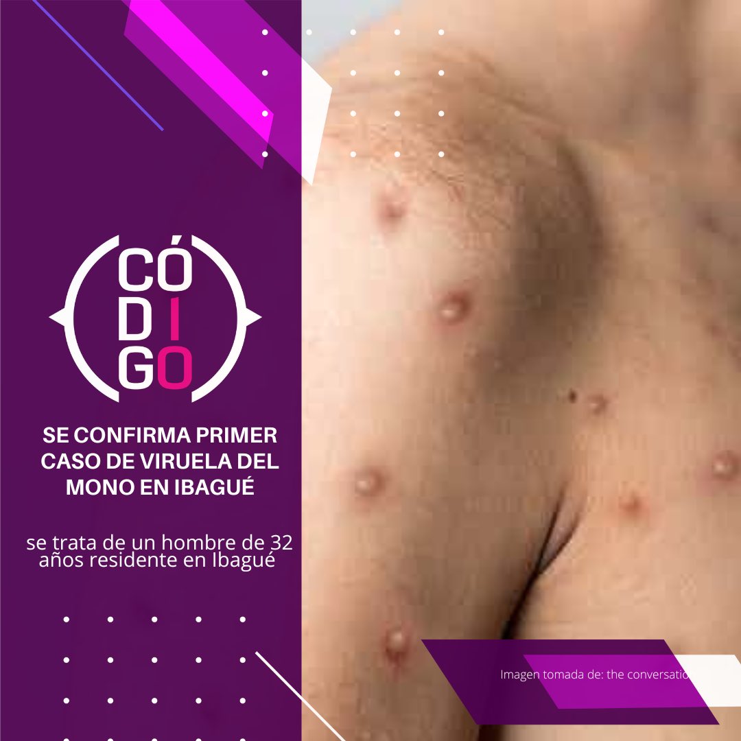 Codigo10notici1's tweet photo. #ATENCIÓN: 🚨 Se confirma Primer caso de viruela del mono en #Ibagué 

Se trata de un paciente masculino de 32 años de edad, residente  en Ibagué que presentó sintomatología asociada a esta enfermedad después de realizar un viaje a Estados Unidos.

https://t.co/CqIEgMwnDV https://t.co/PPXP34utHT
