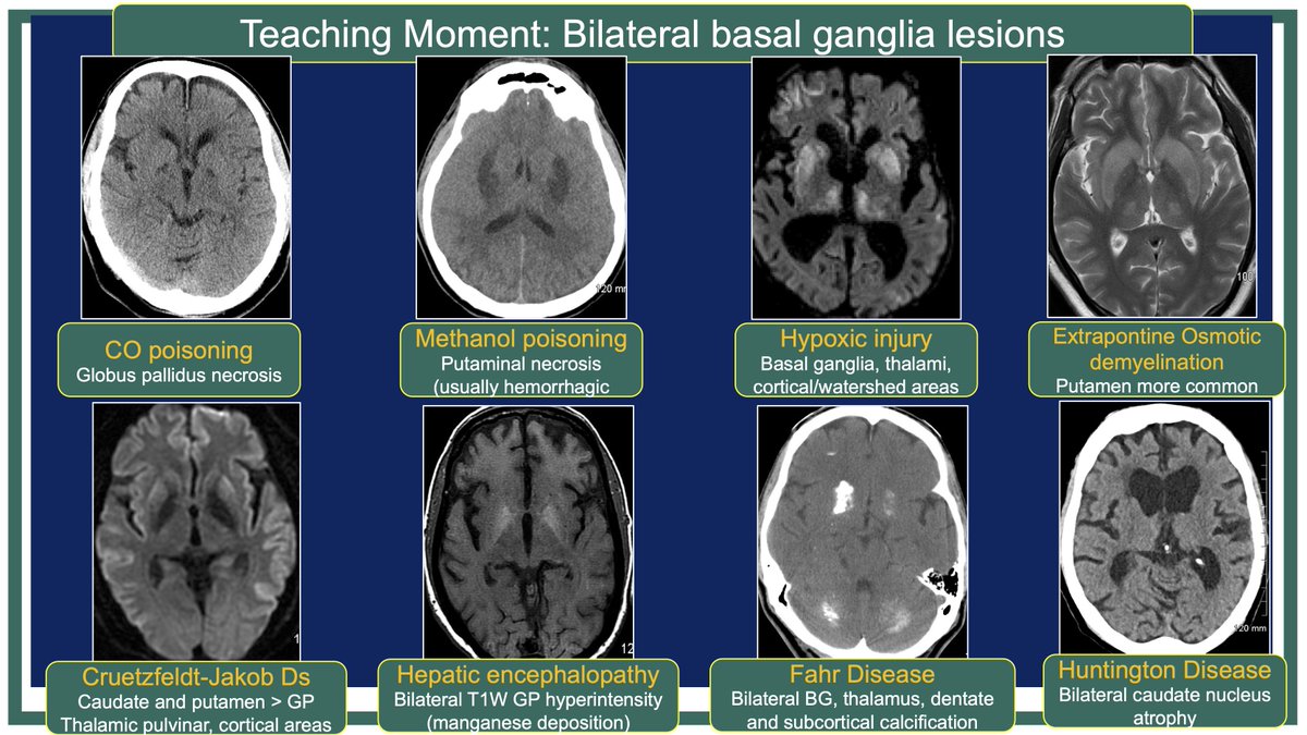 @X (@publishedxprime) on Twitter photo #MCWNeuroradBTW 077Ans: Methanol
#TeachingMoment on BG lesions
#FOAMed #radres #MedEd <a href="/TheASNR/">The American Society of Neuroradiology</a> <a href="/ARRS_Radiology/">ARRS</a> <a href="/BSHNI_UK/">British Society of Head & Neck Imaging</a> <a href="/ESNRad/">ESNR</a> <a href="/BshniTrainees/">BSHNI Trainees</a> <a href="/ESHNRSociety/">ESHNR</a> <a href="/bdoop3210/">Brian Dupree</a> <a href="/MCWNeurorad/">MCW Neuroradiology</a> <a href="/AwanRad/">Omer Awan MD MPH</a> <a href="/aaronrutman/">Aaron Rutman, MD</a> <a href="/RadDiscord/">RadDiscord</a> @AURtweet <a href="/FatimaElahi21/">Fatima Elahi</a> <a href="/drSurjthVattoth/">Surjith Vattoth</a> <a href="/SalmanQureshiDr/">Salman Qureshi</a> #MCWNeuroradBTW 077Ans: Methanol
#TeachingMoment on BG lesions
#FOAMed #radres #MedEd <a href="/TheASNR/">The American Society of Neuroradiology</a> <a href="/ARRS_Radiology/">ARRS</a> <a href="/BSHNI_UK/">British Society of Head & Neck Imaging</a> <a href="/ESNRad/">ESNR</a> <a href="/BshniTrainees/">BSHNI Trainees</a> <a href="/ESHNRSociety/">ESHNR</a> <a href="/bdoop3210/">Brian Dupree</a> <a href="/MCWNeurorad/">MCW Neuroradiology</a> <a href="/AwanRad/">Omer Awan MD MPH</a> <a href="/aaronrutman/">Aaron Rutman, MD</a> <a href="/RadDiscord/">RadDiscord</a> @AURtweet <a href="/FatimaElahi21/">Fatima Elahi</a> <a href="/drSurjthVattoth/">Surjith Vattoth</a> <a href="/SalmanQureshiDr/">Salman Qureshi</a>