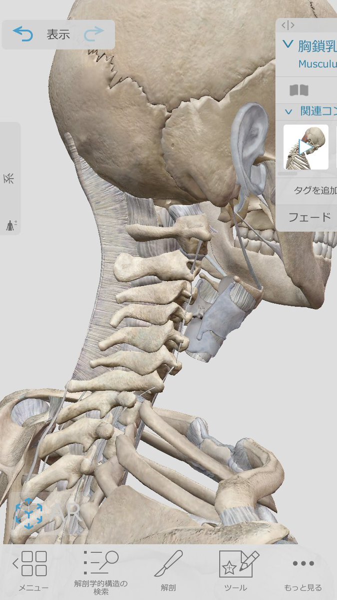 182HR's tweet photo. 更新すると言いながら。
もう8月...
さっき見た記事から少し。
頚椎ヘルニアと診断されると知らない人は絶望する。
医者は牽引か固定か、手術。
骨しか見てなかったら当然。
この周りには多くの筋肉があって
筋肉と温めからの血流改善で
痛み痺れ可動改善した例は自分が見た中にも何人もいます。 https://t.co/uB5ujxG3pV