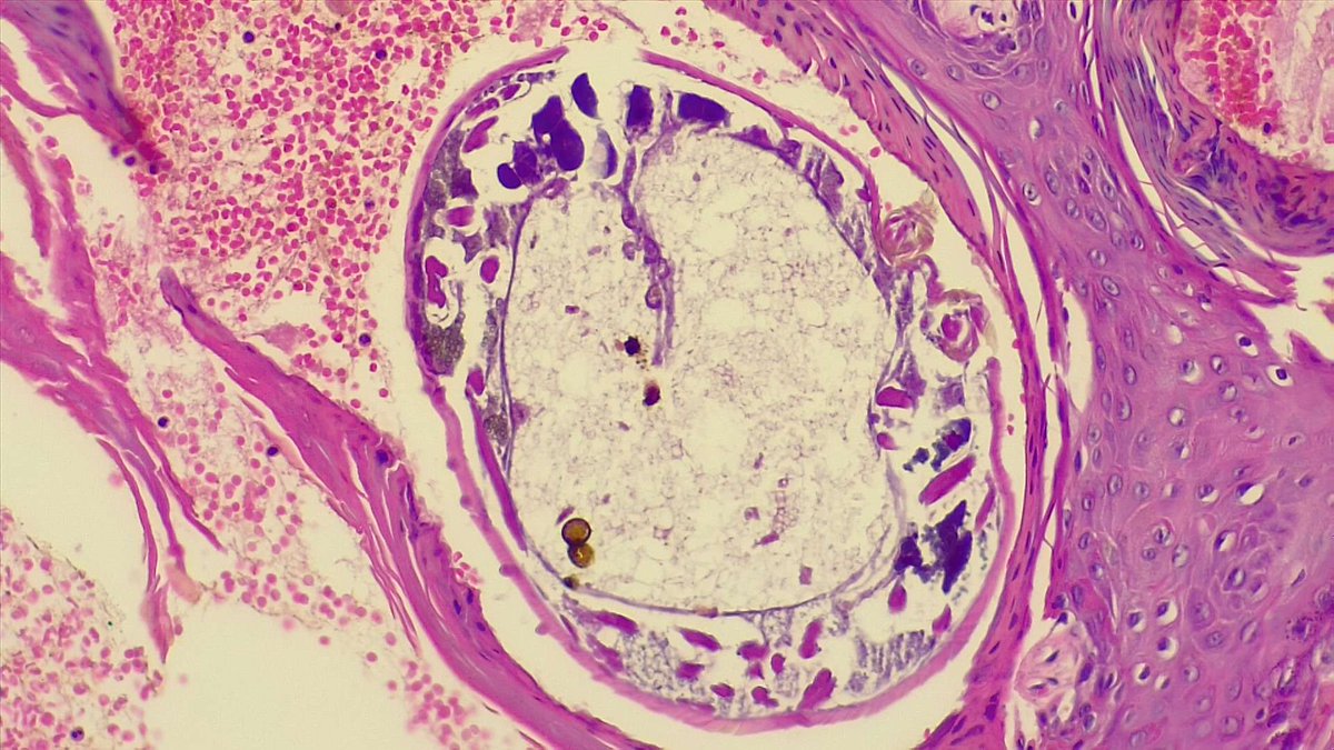 BuddingLiska's tweet photo. Especially for @DrlegrangeDan 🤓 an uninvited guest present in a skin lesion https://t.co/XCZtvub3iw