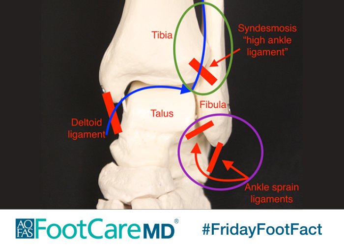 With football preseason underway, you may be hearing more about syndesmotic injuries, often called 'high ankle sprains.' What is a high ankle sprain and how do foot & ankle orthopaedic surgeons treat them? Learn more on #FootCareMD: ow.ly/gWva50Kc8bu #FridayFootFact