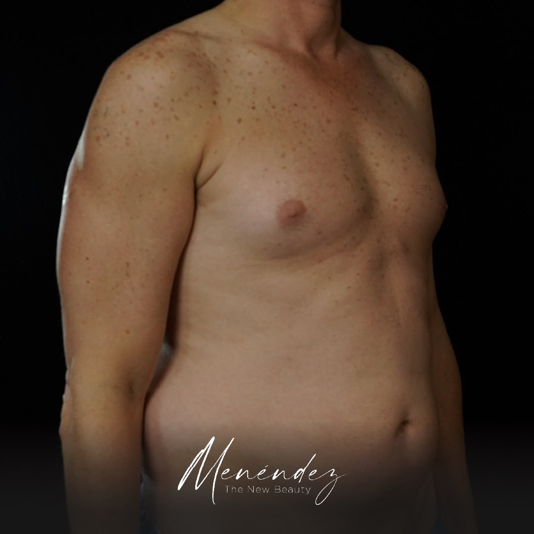 DrJPMenendez's tweet photo. BodyPHIcation: Lipoescultura HD - Total Definer es un conjunto de procedimientos y tecnologías combinadas que permite marcar los abdominales y la musculatura de los brazos, el dorso y las piernas. 

Antes sólo se podía conseguir con entrenamientos y dietas estrictas https://t.co/QN77v5KufD