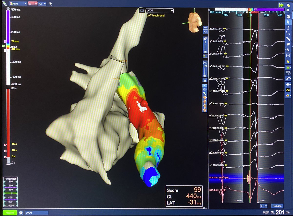DrMCardiology's tweet photo. A nice “one-burner” in the LVOT just inferior to the LCC. Thanks for the support @tlcbushey and @MapsForDays. Propagation map to follow. #hdgrid @AbbottCardio #epeeps https://t.co/OpModIWtQB