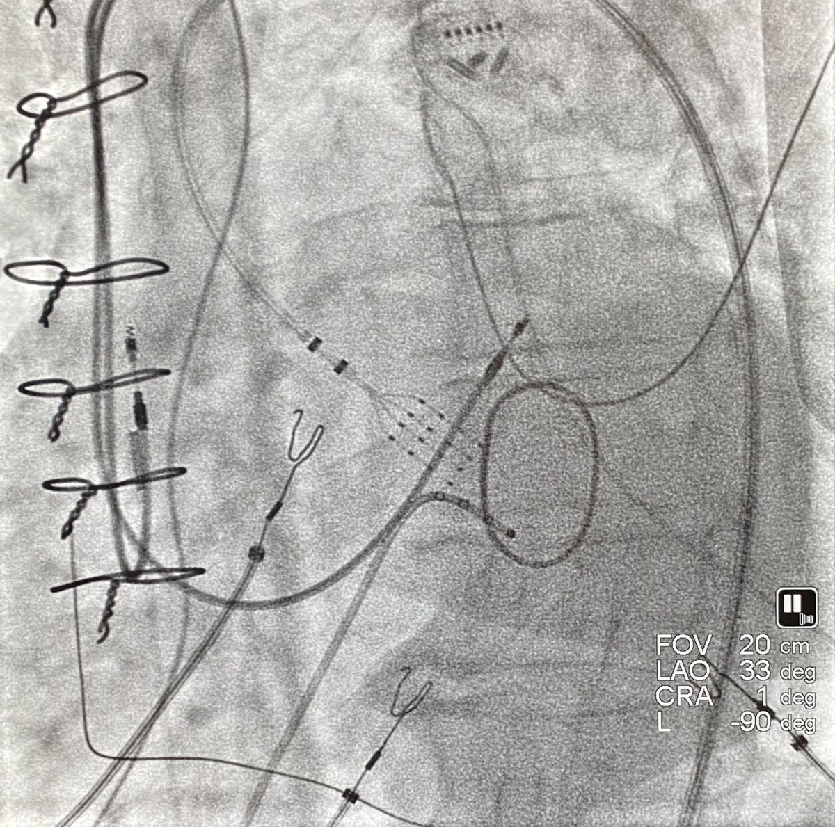 DrMCardiology's tweet photo. A nice “one-burner” in the LVOT just inferior to the LCC. Thanks for the support @tlcbushey and @MapsForDays. Propagation map to follow. #hdgrid @AbbottCardio #epeeps https://t.co/OpModIWtQB