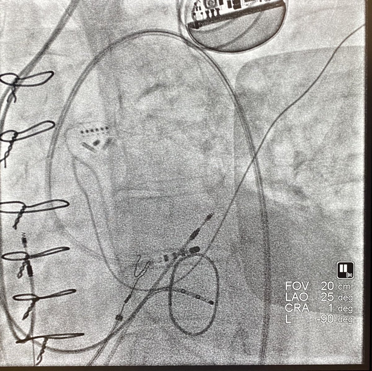 DrMCardiology's tweet photo. A nice “one-burner” in the LVOT just inferior to the LCC. Thanks for the support @tlcbushey and @MapsForDays. Propagation map to follow. #hdgrid @AbbottCardio #epeeps https://t.co/OpModIWtQB