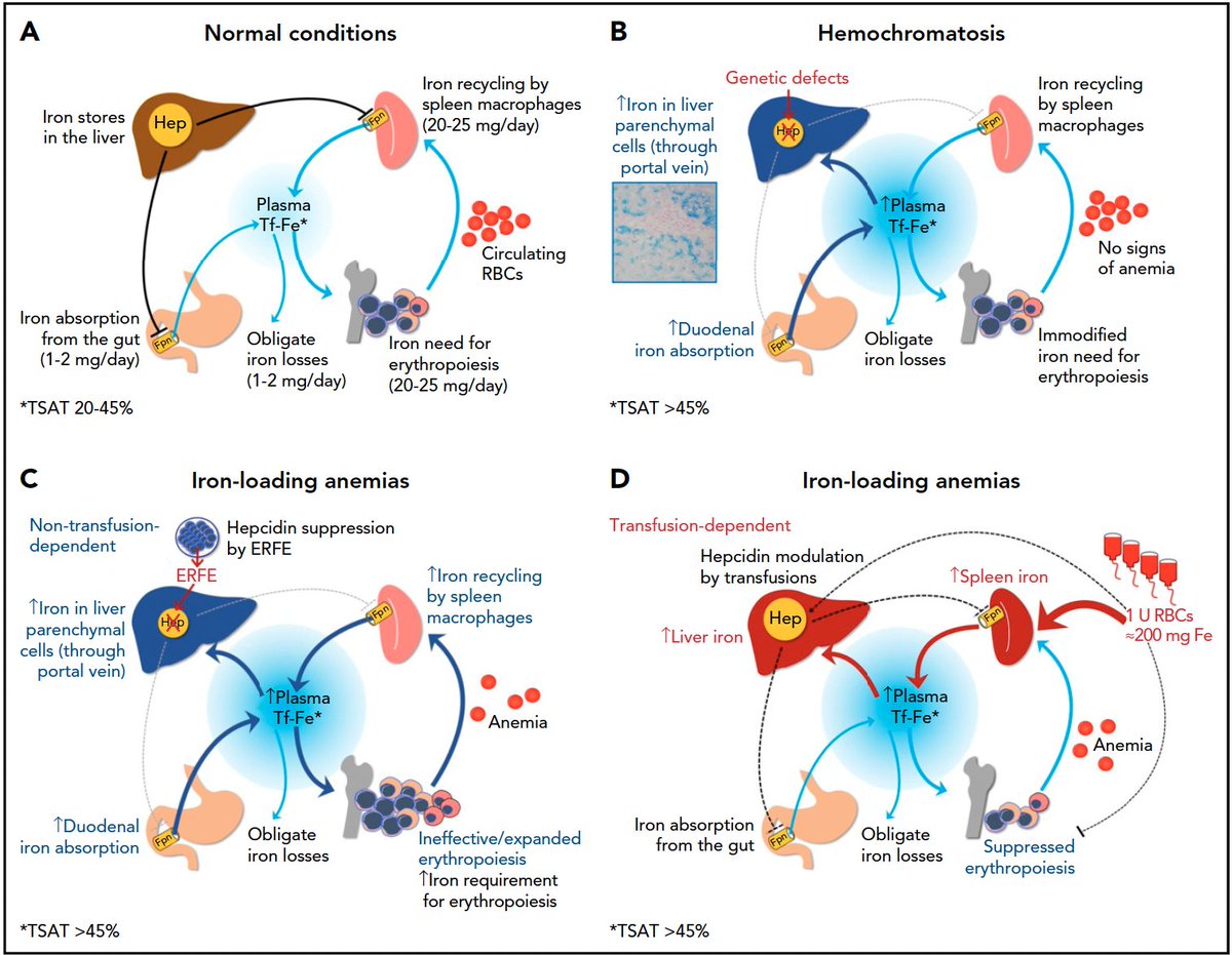 MikeDScottMD's tweet photo. Finally got around to reading this great article (been sitting on my desktop forever)
https://t.co/rPqnRfHoEA
I particularly loved this figure differentiating various pathophysiologic causes of iron overload; definitely bookmarking for teaching!
@sholzberg @tsengeric https://t.co/Ja4ifwGZqx