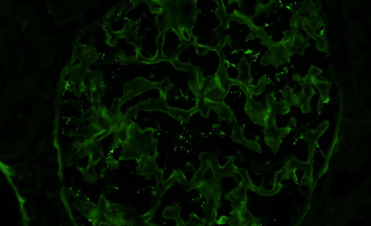 Podocyte "dusting" in minimal change disease, suspicious for presence of anti-nephrin antibodies. #renalpath #nephropath