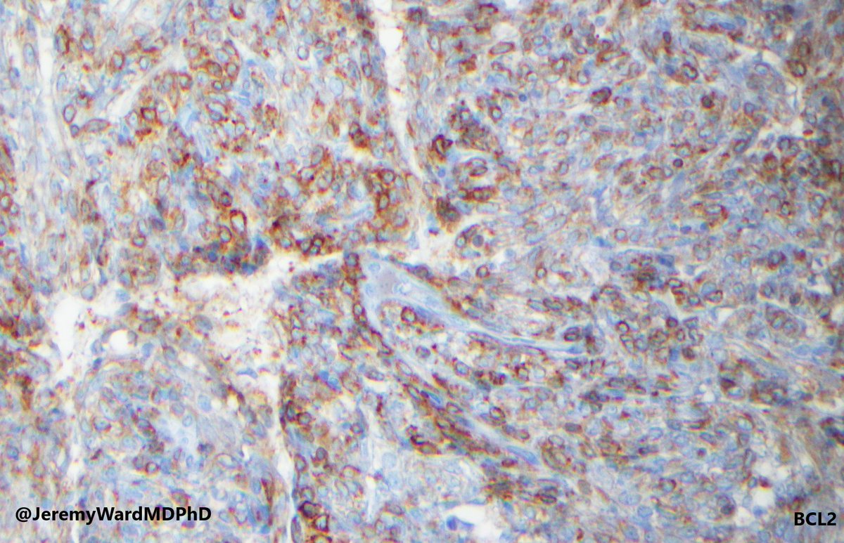 Patient with history of pneumothorax. S/p wedge biopsy. Diagnosis: lymphangioleiomyomatosis. PMID: 34461049  #pathology #lungpath #PathTwitter