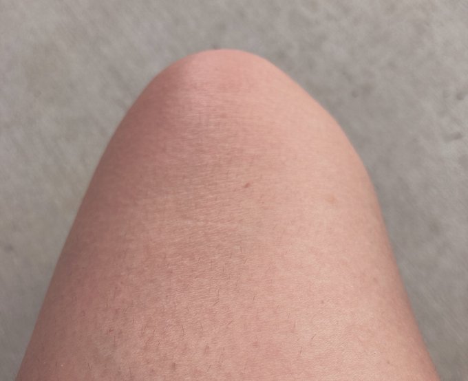 No guys that&rsquo;s not my knee cap 😂 I woke up today &amp; my knee has a huge bump on it. It&rsquo;s extremely painful<a href="/tag/live"class="tags"><span>#live</span></a><a href="/tag/findom"class="tags"><span>#findom</span></a><a href="/tag/mfc"class="tags"><span>#mfc</span></a><a href="/tag/cashappamerica"class="tags"><span>#cashappamerica</span></a>