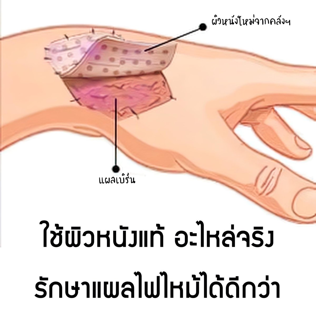 ช่วยแชร์หน่อยนะคะ  สภากาชาดไทยเขามีผิวหนังของคนที่มาบริจาคไว้ สามารถช่วยเหลือคนประสบอุติเหตุเกี่ยวกับไฟไหม้ได้ ติดต่อ1666 ได้เลยนะคะ ยังมีคนไม่รู้อีกมาก ถ้าช่วยเเชร์กันอย่างน้อยเผื่อสามารถช่วยใครได้มากขึ้นนะคะ #ไฟไหม้ผับชลบุรี #ไฟไหม้ผับสัตหีบ #แผลไฟไหม้ #สภากาชาดไทย