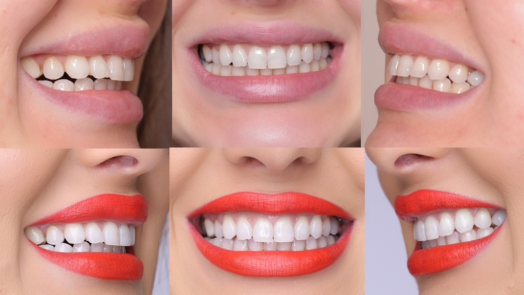 Do you avoid bright lipstick? If you're concerned about drawing attention to stained teeth, you don't have to be. You can remove all stains, even the deepest and oldest, with an effective teeth whitening system. @aliandreeamakeup #teethwhitening #mua 

Photo: @aliandreeamakeup