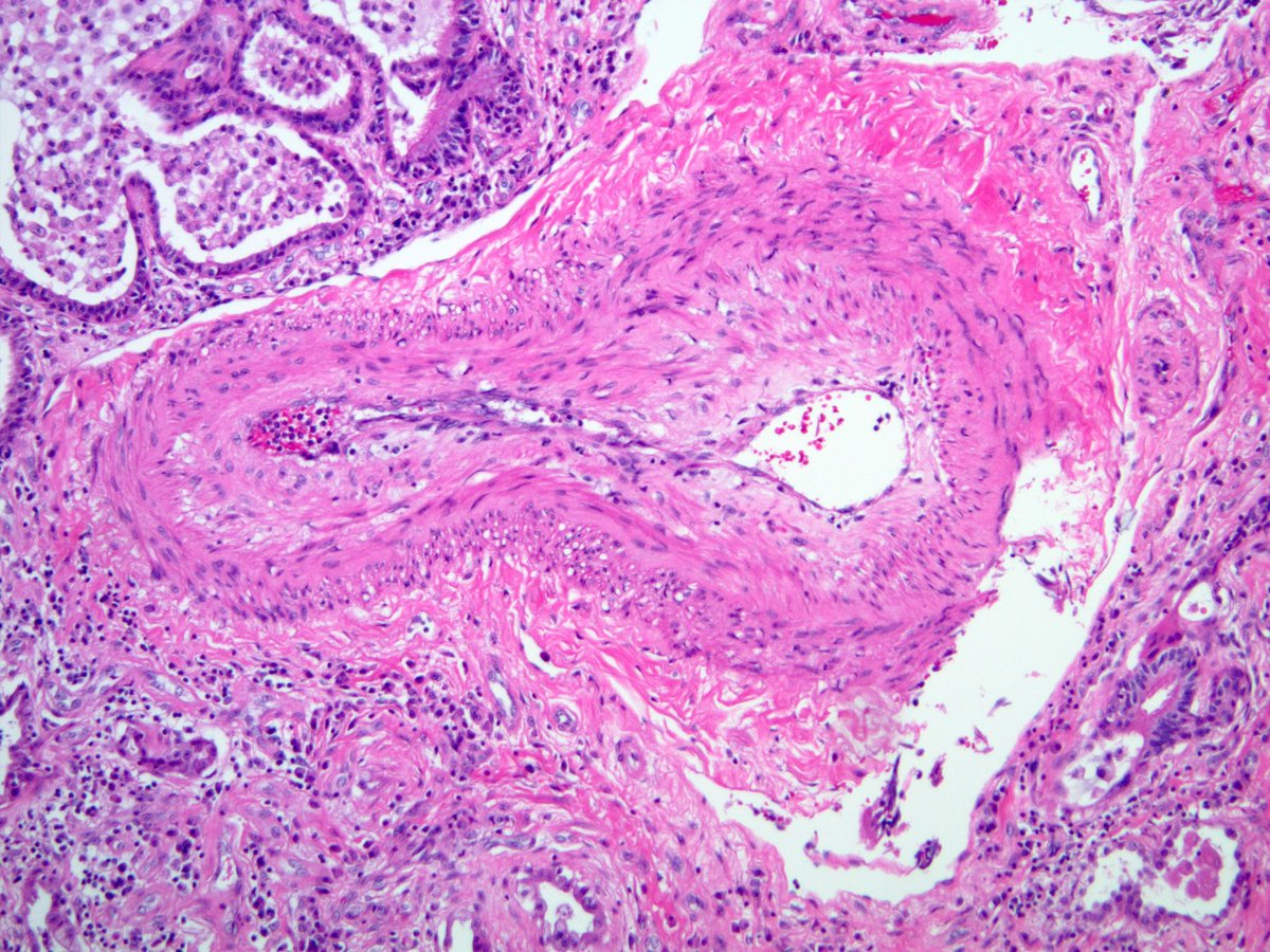smlungpathguy's tweet photo. Thick arteries (with striking medial hypertrophy) are a common finding in UIP. Don’t get fooled into thinking that they are specific for pulmonary hypertension! 

What is UIP? Read this 👇🏾🔬
https://t.co/ovpy3ioG3E

#FibroblastFocusFriday https://t.co/9OCFoWPnSl