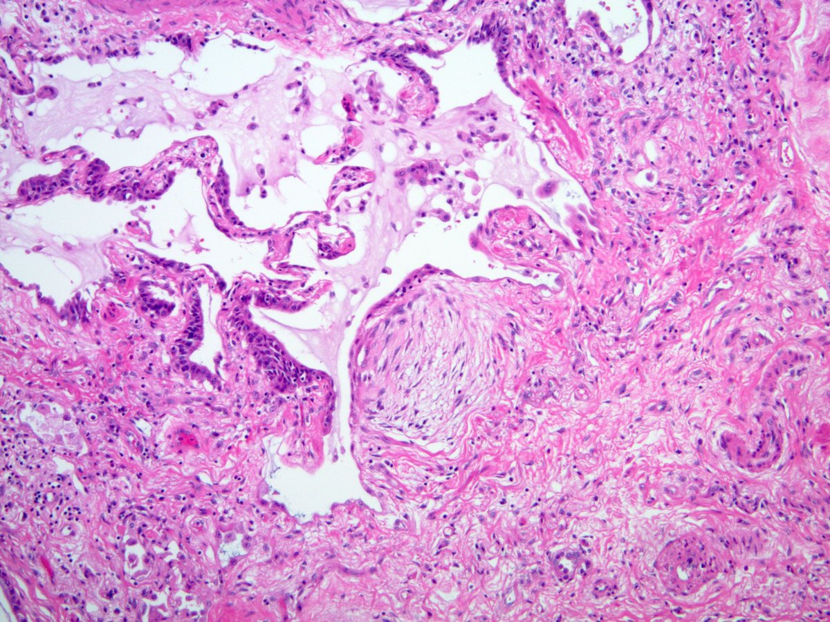 Thick arteries (with striking medial hypertrophy) are a common finding in UIP. Don’t get fooled into thinking that they are specific for pulmonary hypertension! 

What is UIP? Read this 👇🏾🔬
nature.com/articles/s4137…

#FibroblastFocusFriday