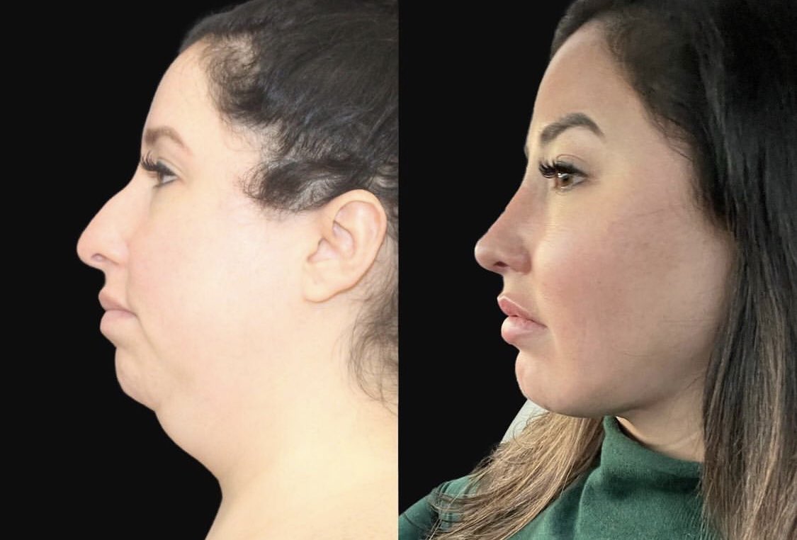 The Cosmetic Lane on Twitter "This 34 year old patient spent between