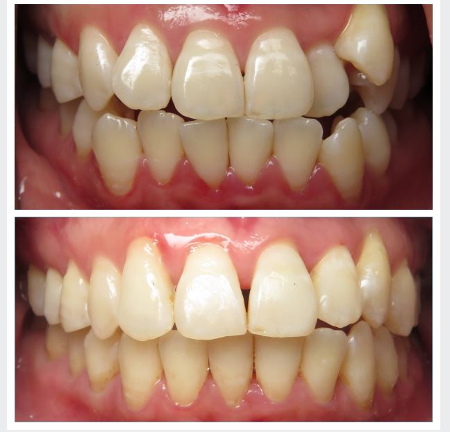 The power of a great smile can be achieved for many through Invisalign treatment! #invisalignsmile #invisalign #amatodentalgroup #dentistrylife #dentist #smile  #happypatient #topdentistseattle #seattle #seattletopdentist #beautifulsmile #dentistry