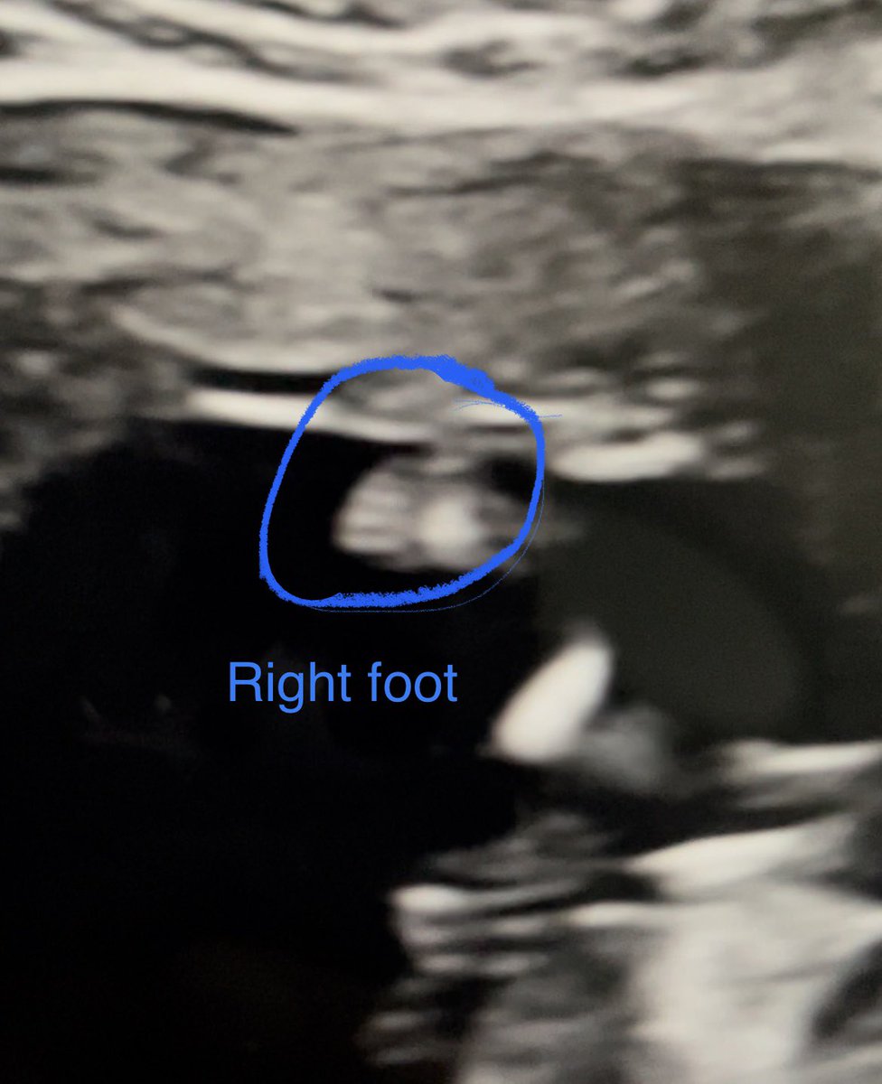 unconventi's tweet photo. My poor baby got my spider toes 😩 https://t.co/OZohmbSMAf