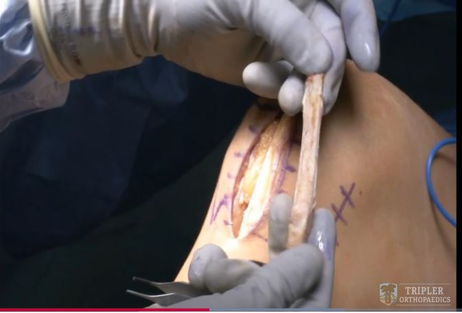 Ready to see a novel technique for #ACL graft? Watch this #orthopedic video on Bone-Tendon-Autograft (BTA) Anterior Cruciate Ligament Reconstruction: bit.ly/3P1yFde #OVTFridays <a href="/tripleramc/">Tripler Army Medical Center</a> @AOSSM_SportsMed