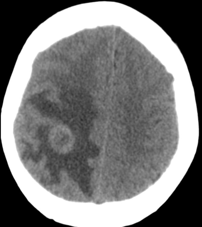 TheAJNR's tweet photo. #AJNRcow >> August 4, 2022 >> A 45-year-old woman with a history of focal segmental glomerulosclerosis status post kidney transplant on immunosuppression presents with subacute weakness, paresthesias, &amp; a shaking episode of her left arm. View the case at https://t.co/ijZmFfVjLc. https://t.co/85IbMrpLdS