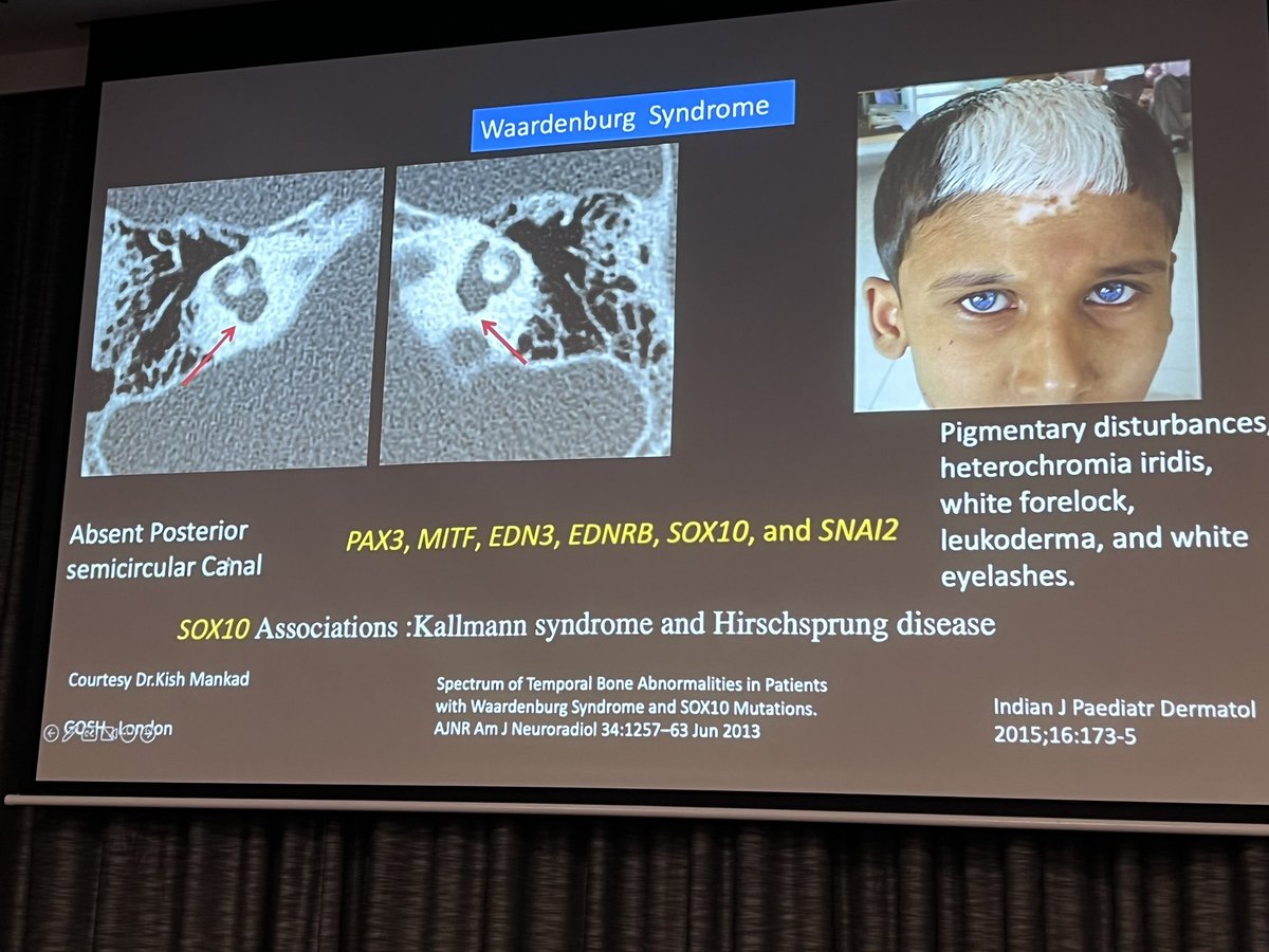 One of the finest spinners Dr Prasad Hanagandi delivers a comprehensive update on genotype phenotype correlations in labyrinthine dysplasias. Inner ear malformations so practically covered! Watch the space for the #SPIN22 proceedings in recorded format.