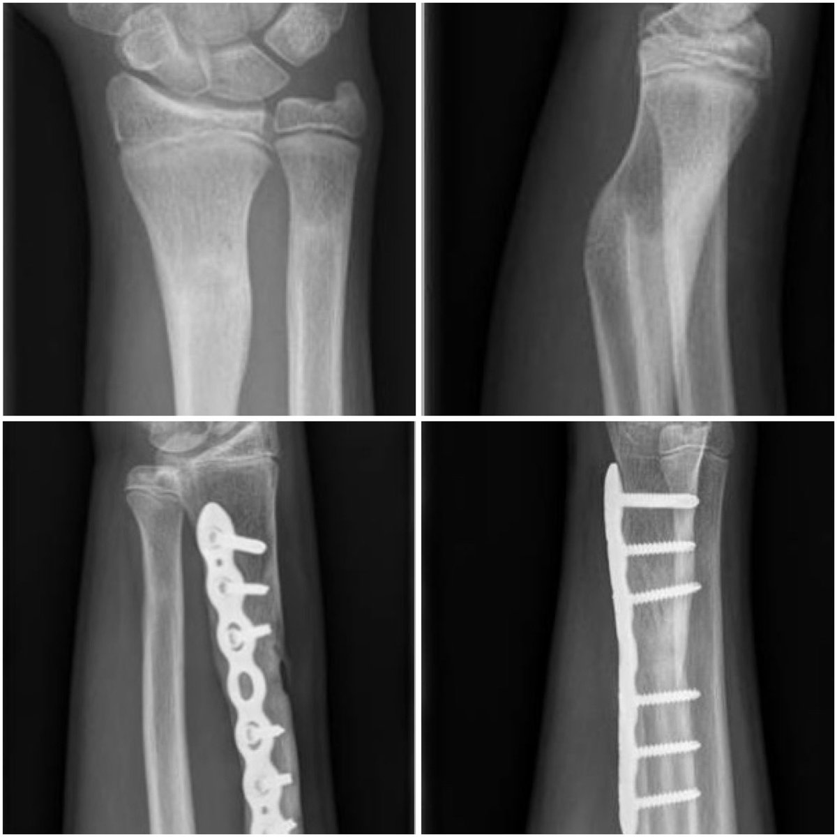 #3Dprinting young patient  with distal antebrachium malunion. Limited pro- and supination. Corrective osteotomie using 3Dprinted molds using in-house <a href="/Ultimaker/">UltiMaker</a> S5 and <a href="/formlabs/">Formlabs</a>. 1y results; full range of motion. <a href="/3DLab_ETZ/">ETZ In-Hospital 3D Lab</a> <a href="/3DLabRadboudumc/">3D Lab Radboudumc</a> <a href="/ETZnl/">ETZ</a> #traumasurgery