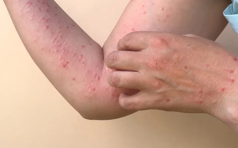 Confirma Jalisco seis nuevos casos de viruela símica, suman 28
 mile.io/3d7cgxW