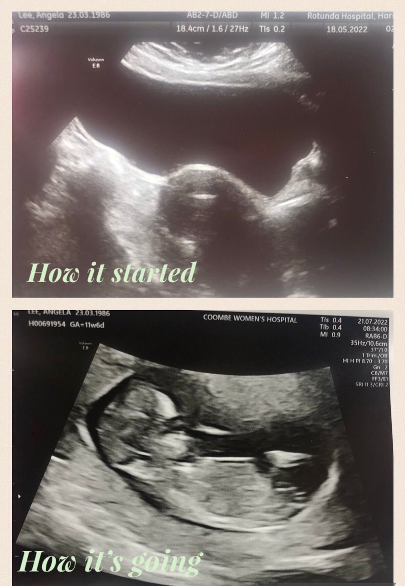 Breaking News 😂 so after another bout of IVF Saoírse is delighted to announce she is going to be big sister in February 2023. A lot of you may know as Saoírse is telling everyone she has seen in recent days.