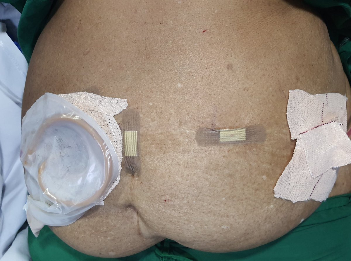 True advantage of minimally invasive surgery, without major scar. Robotic anterior exentration with total intracorporeal ilial conduit. Recently did my 2nd case in female with high BMI. 1st one was 130kg, 2nd one 80 kg.