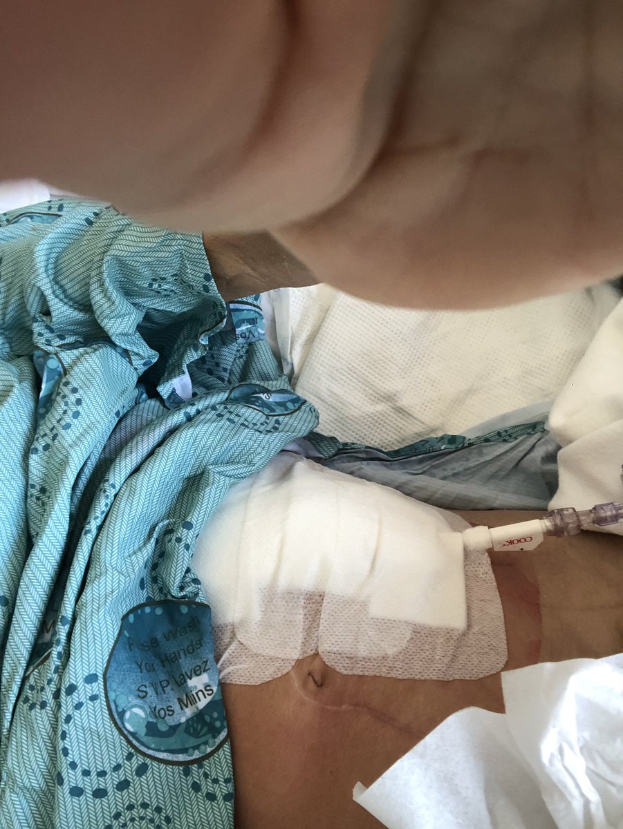 BodineWaterfire's tweet photo. A small surgery to get this thing out of my face . No I still cannot eat or drink anything thing but ice chips and a lot of IV fluids and meds. https://t.co/cj3Mizeb8P