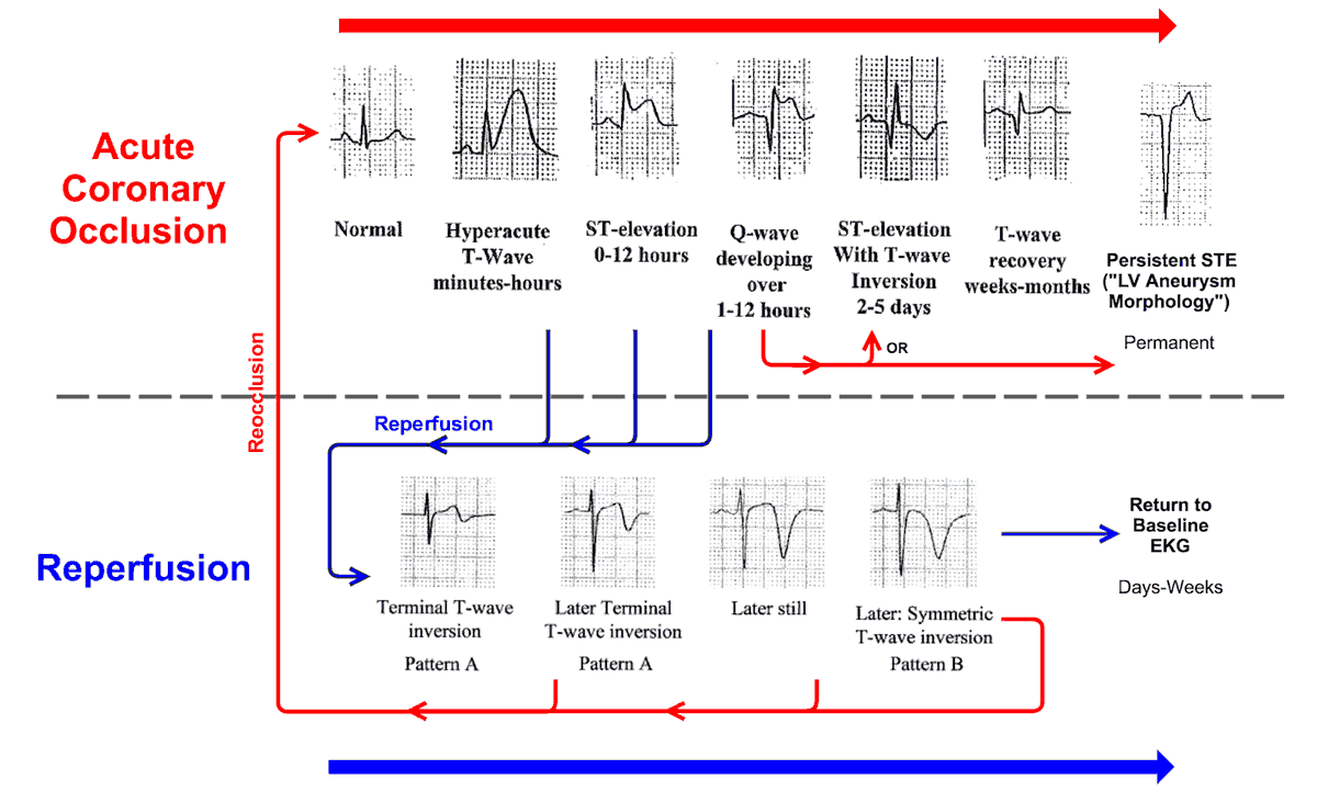 manual-of-medicine-on-twitter-the-progression-of-ecg-findings-seen