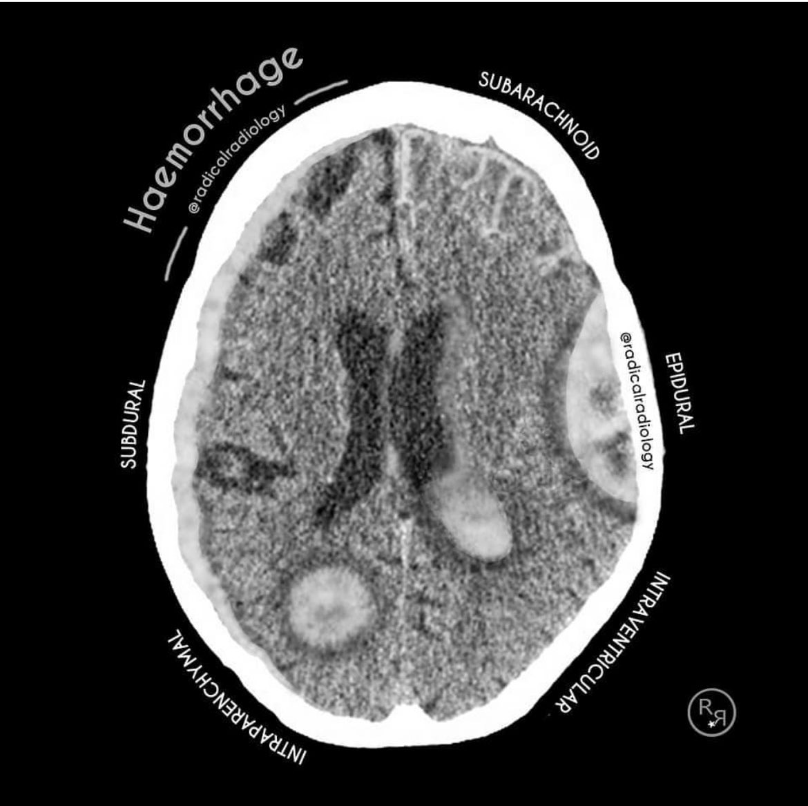 Be able to Differentiate all brain bleeds on CT